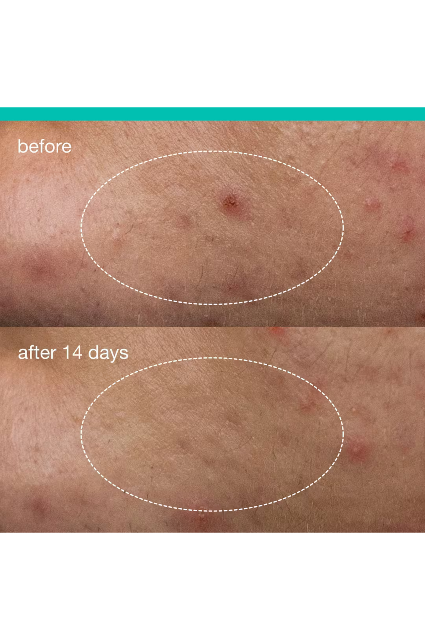 Deep Acne Invisible Liquid Patch