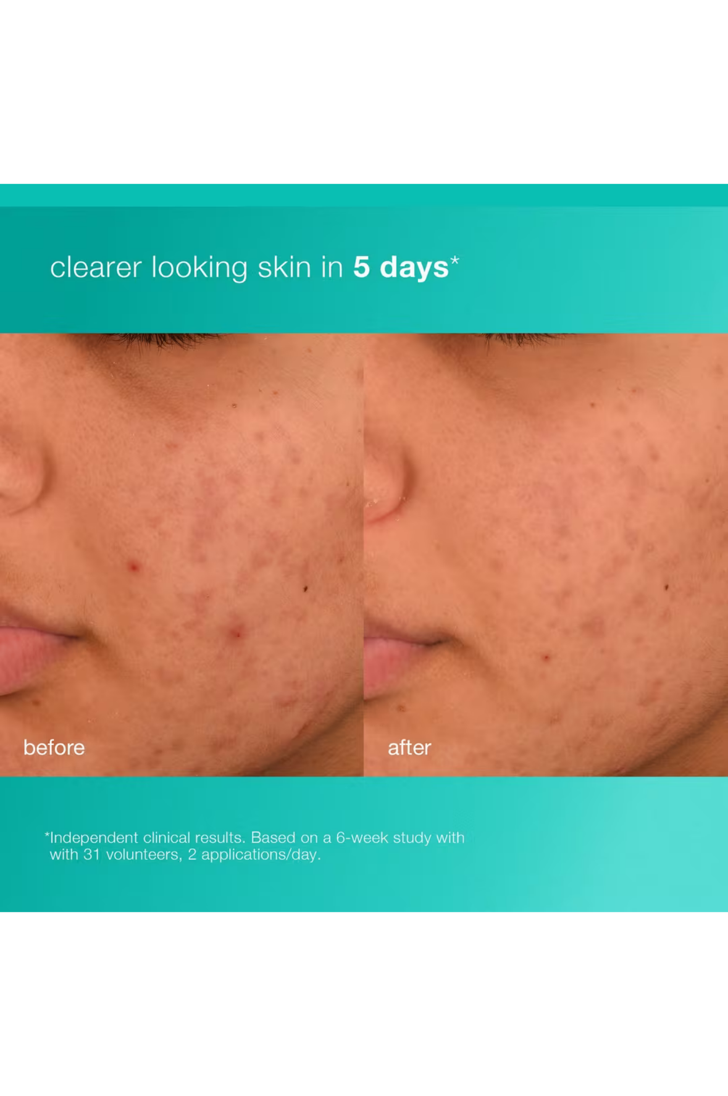 Acne Biotic Moisturizer