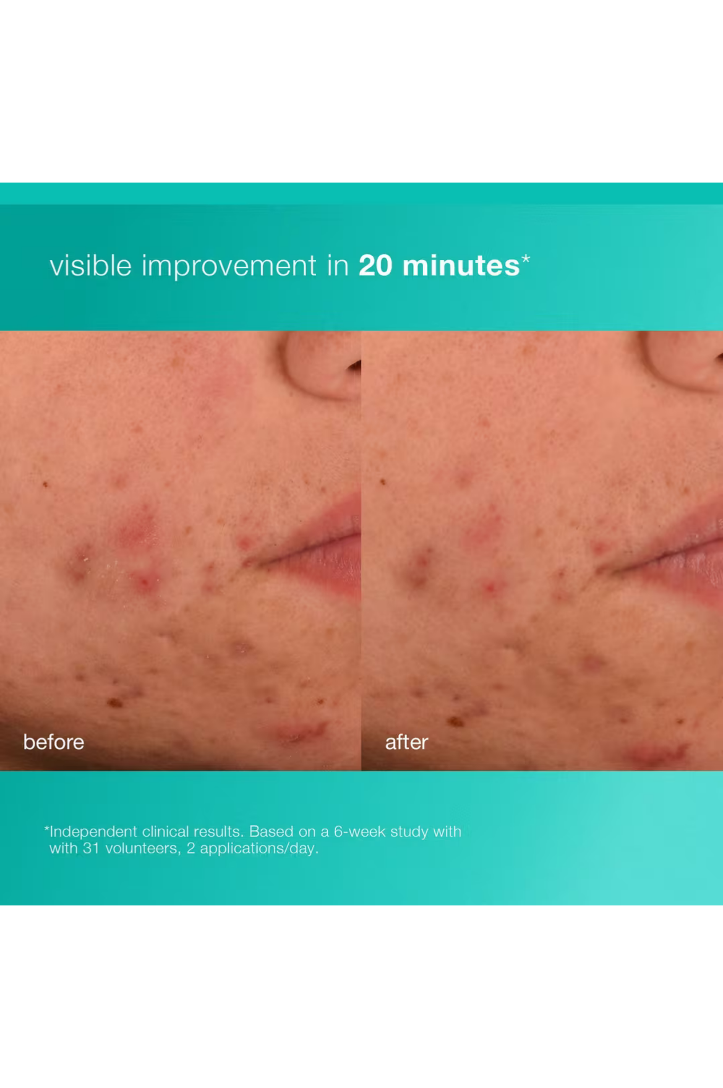 Acne Biotic Moisturizer