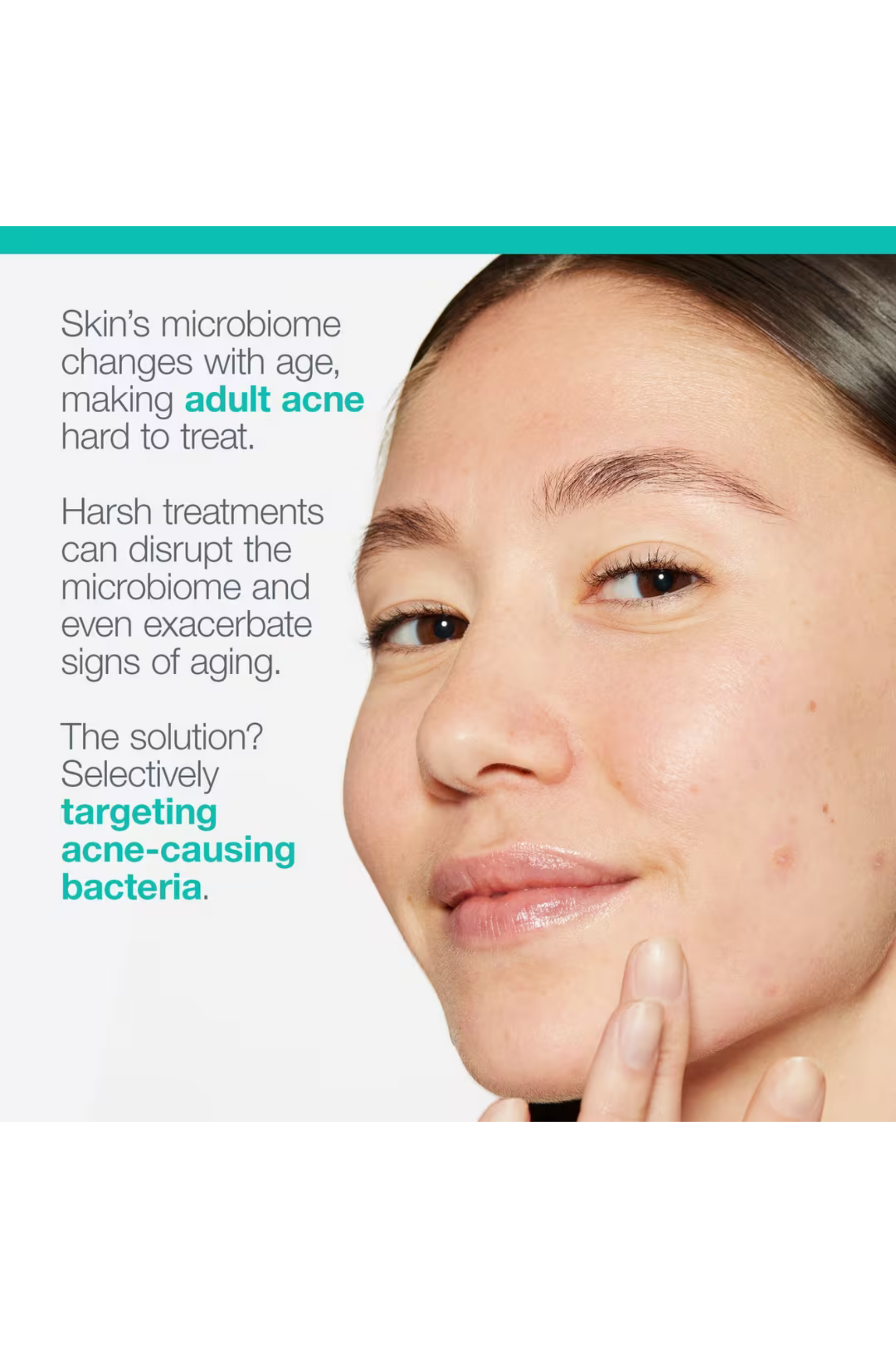 Acne Biotic Moisturizer