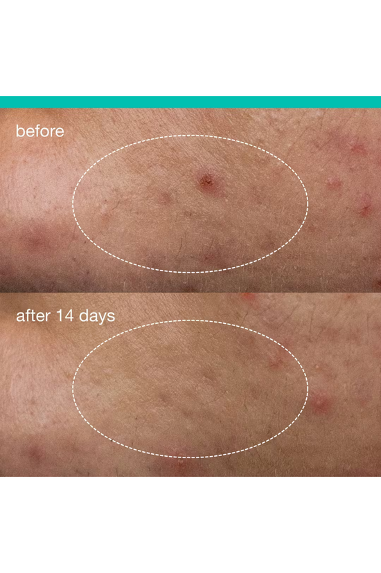Deep Acne Invisible Liquid Patch
